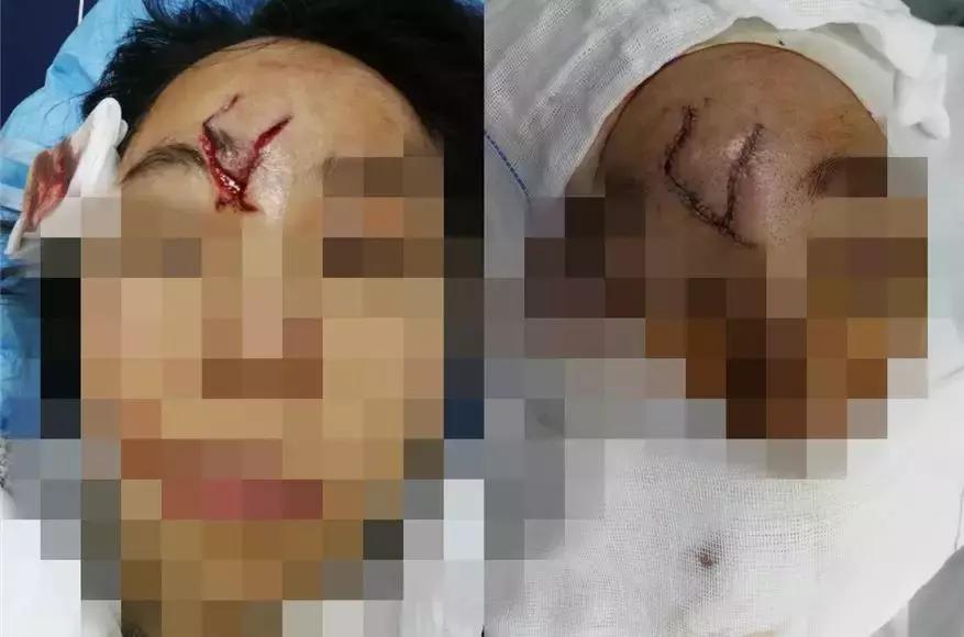 苏州科技城医院烧伤整形科｜谨防烧烫伤，变成一个更美好的你