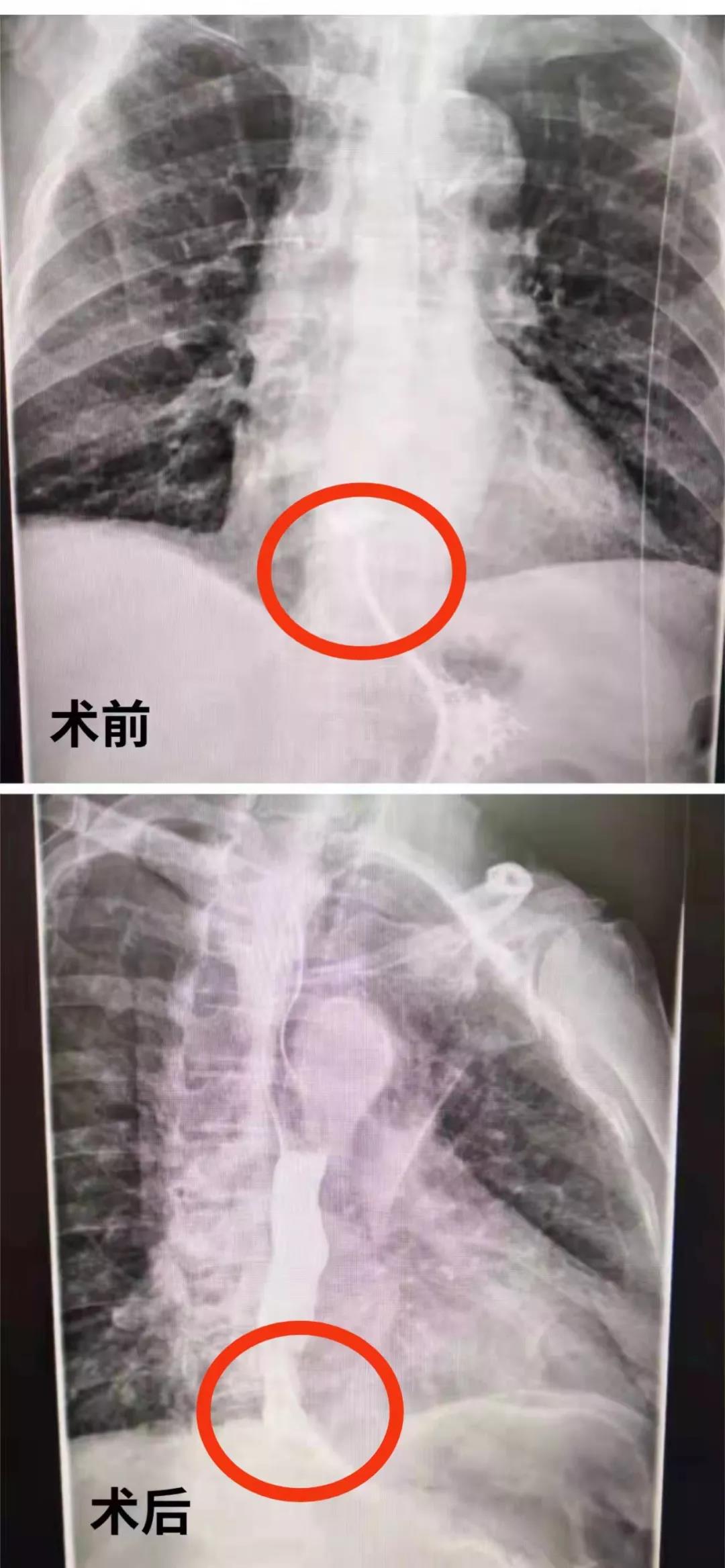 *安泰**市中心医院完成市首例弥漫性食管痉挛合并贲门失弛缓肌切开术