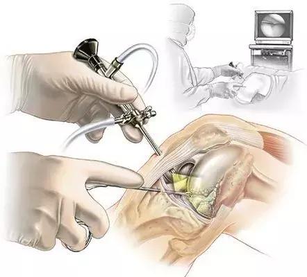 关于膝关节疼痛你一定有好多疑问,类风湿性关节炎患者常见问题解答