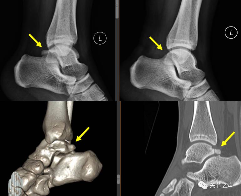 小伙打球崴脚过后检查跟腱断裂,小伙打球崴脚