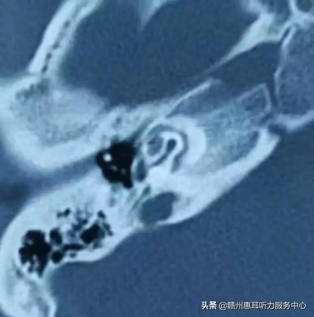 耳硬化症通过什么检查,耳硬化症的诊疗计划