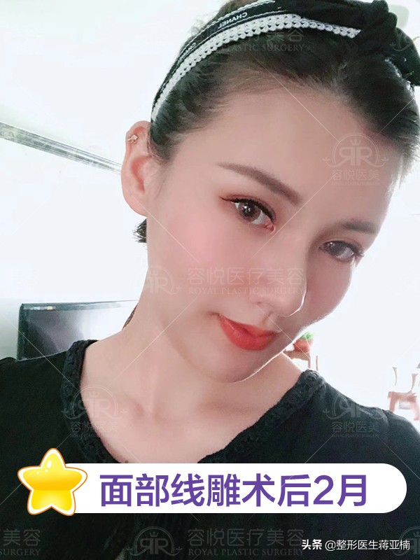 线雕完觉得自己像阿凡达,线雕的真实感受图片