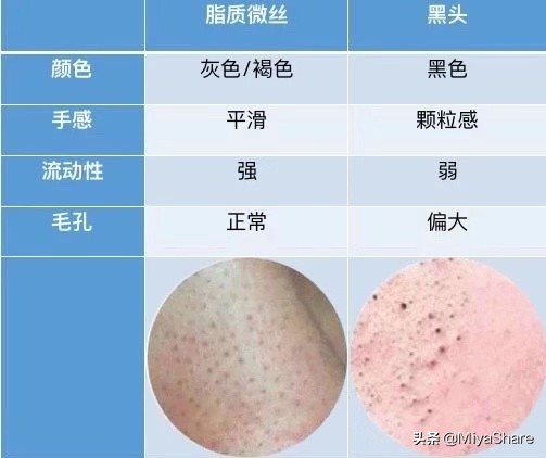 黑头难处理吗,黑头难去怎么办