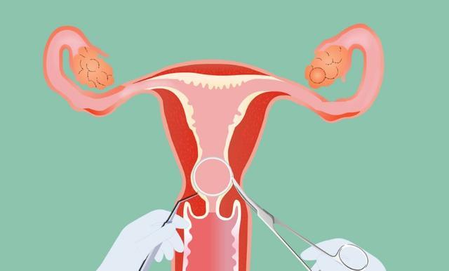 女士避孕上环对身体有没有害处,逼上环