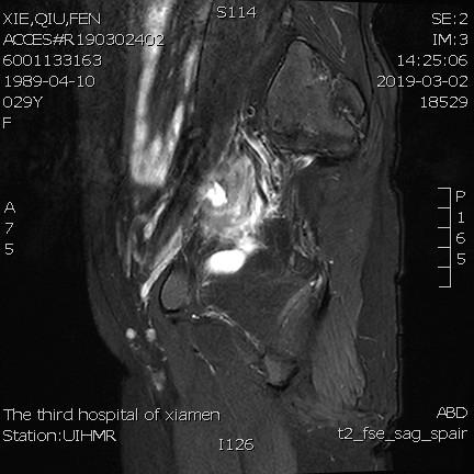 子宫腺肌症称为不死的癌症,子宫腺肌症是不死的癌症吗