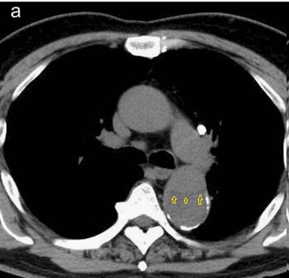 如何监测动脉夹层早期,动脉增强ct能查出主动脉夹层么