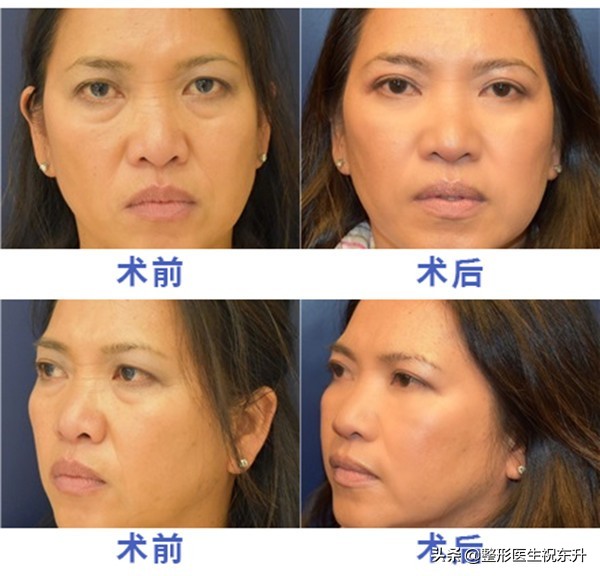 关于祛眼袋那点事,医生讲去眼袋是真的吗