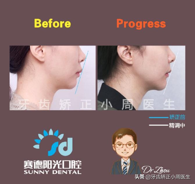 正畸牙齿打骨钉的危害,正畸打骨钉是什么感觉