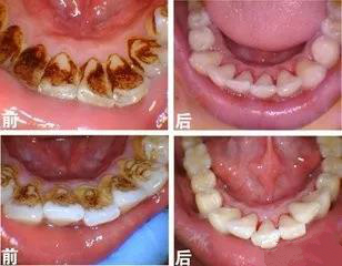 牙齿上面有黑线但是没有洞怎么办,牙齿咬合面有黑线没有洞怎么治疗