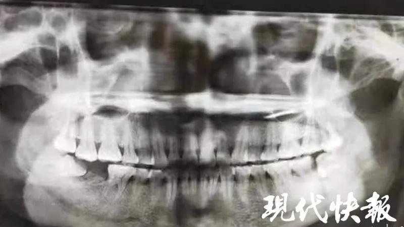 女子智齿烂脸,智齿发炎的真实案例