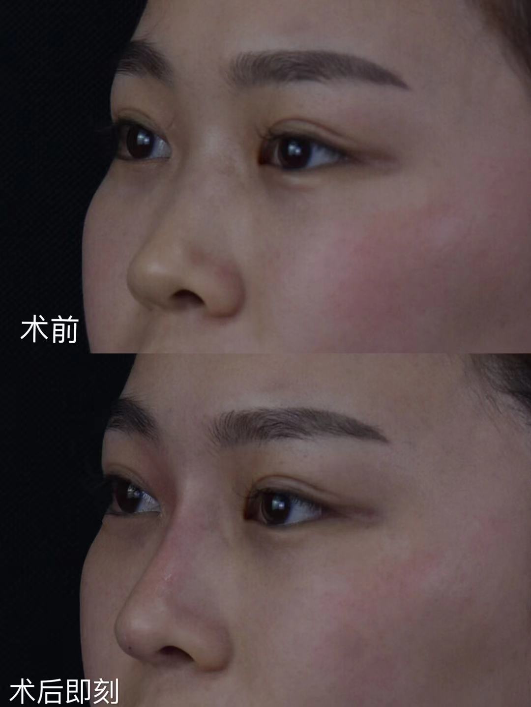 玻尿酸隆鼻鼻子变宽怎么办,玻尿酸隆鼻变宽了还能隆鼻吗