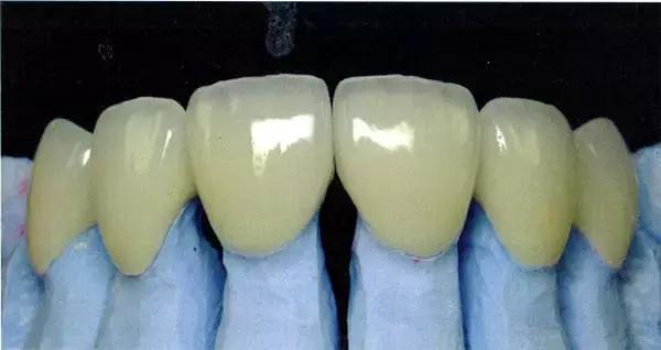 不含重金属的烤瓷牙有吗,诊所100元一颗的烤瓷牙有毒吗