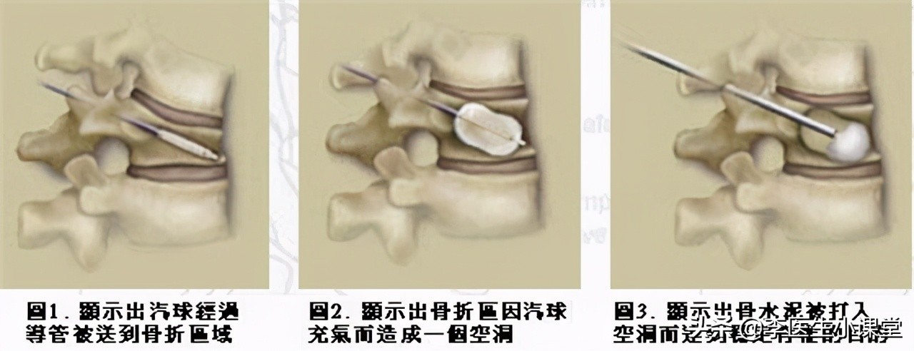 更年期骨质疏松吃什么药止疼好,骨质疏松胳膊疼痛吃什么药止疼