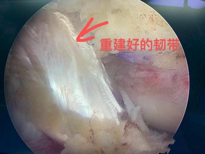 膝关节卡住疼是怎么回事,膝关节卡住是什么意思