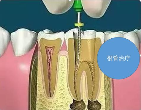 辟谣快速缓解牙疼,辟谣消炎药是抗生素