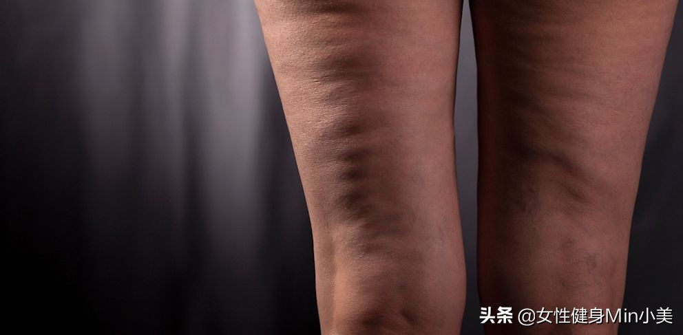 大腿后侧橘皮组织明显怎么办,怎样去掉臀部和大腿后部的橘皮