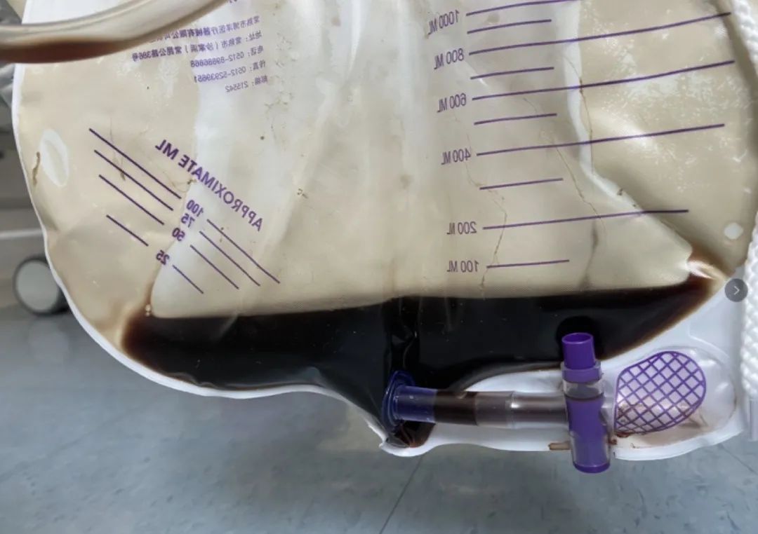 间质性肺病治疗后会加重吗,化疗后肺部间质性的病变