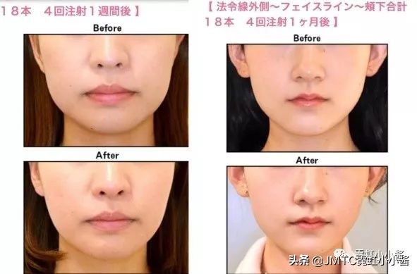 记录翻译小姐姐日本打溶脂针,肉脸变骨感脸全过程|日本医美