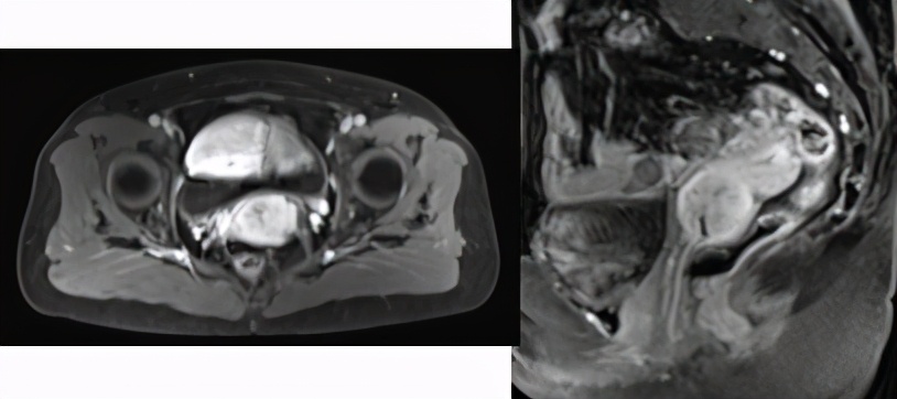 sbrt肿瘤放疗副作用有哪些,复发宫颈癌常用化疗方案