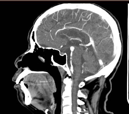 老年人基底动脉瘤几率,脑动脉瘤未破裂最佳治疗方法