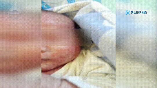 婴儿耳朵和嘴巴一圈红肿,婴儿吃药后嘴巴边上都红肿