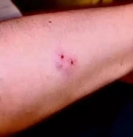 毒蛇咬伤截肢,毒蛇咬食指怎么处理