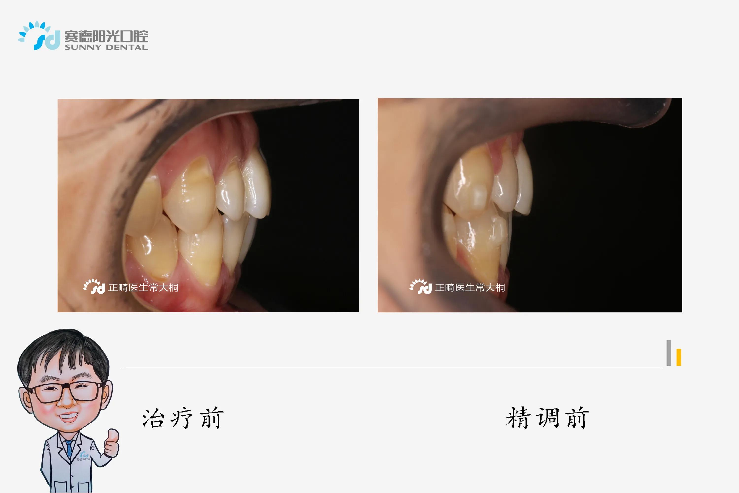 隐适美正畸牙拔掉不美观怎么办,隐适美黑三角什么时候会出现