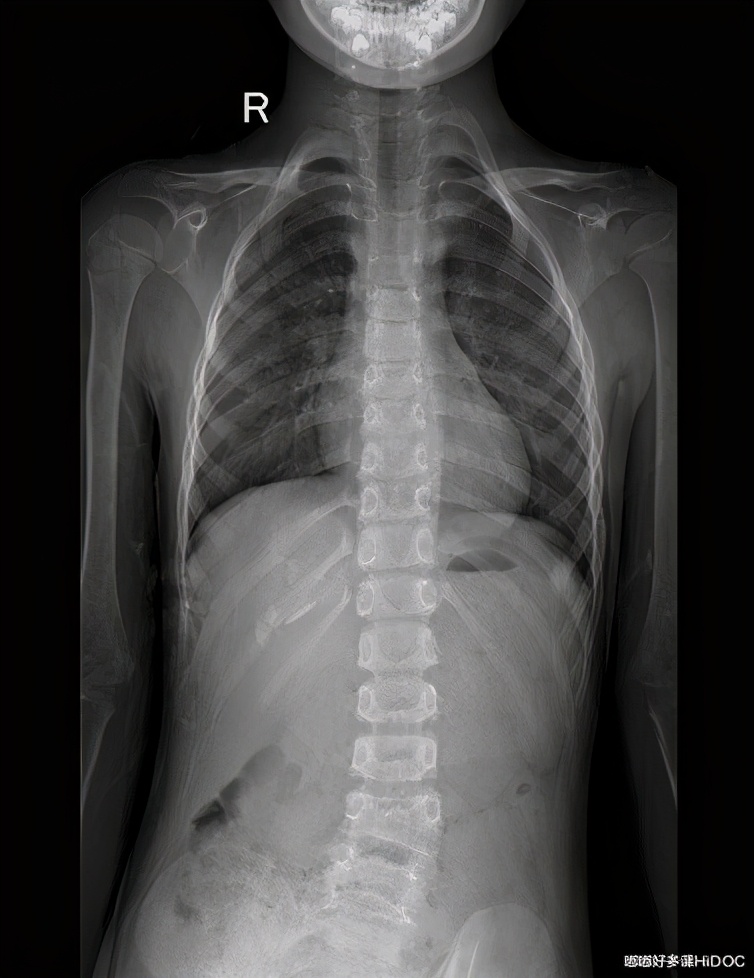 儿童颈椎侧弯会有什么后果,13岁孩子颈椎侧弯矫正睡姿图片