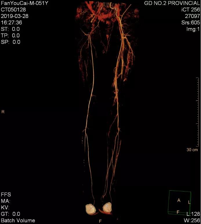 老烟民请注意,老烟民血管收缩