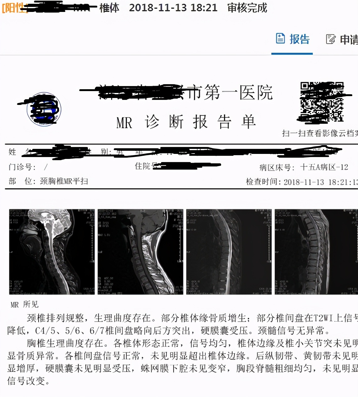 鱼刺卡喉祖传秘方求救,鱼刺卡喉轻松解决快1年了