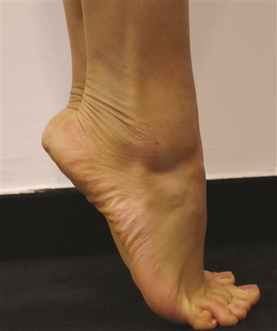 脚趾为什么那么不灵活,脚踝扭伤后恢复后脚趾头不灵活