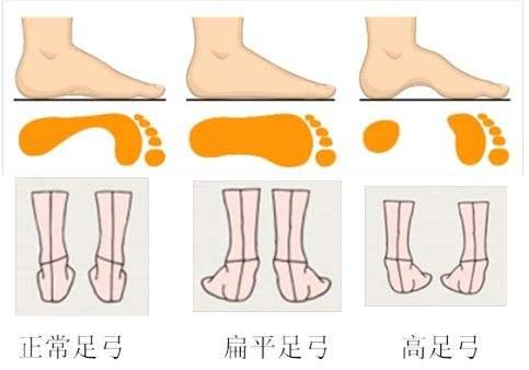 小月龄扁平足可以纠正过来吗,家长不是扁平足小孩却是扁平足