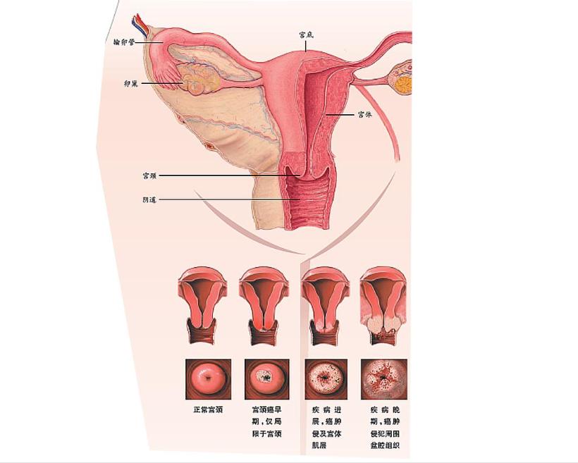 宫颈癌医生说晚期没办法治,宫颈癌前病变三级是什么症状