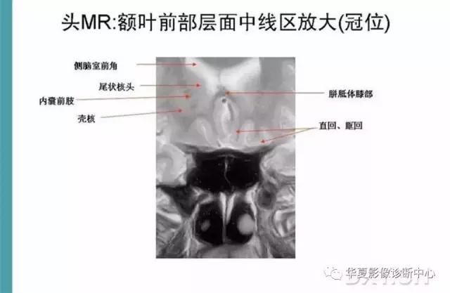 电子版头颅ct与mri断层解剖,头颅mri血管解剖与分段详解