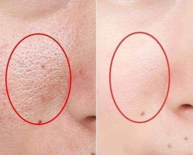 为了变美到底该不该打玻尿酸,玻尿酸注射后变丑了怎么办