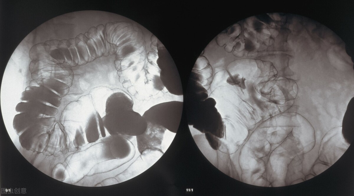 听说过结肠癌、直肠癌，那结直肠癌的结直肠在哪里？