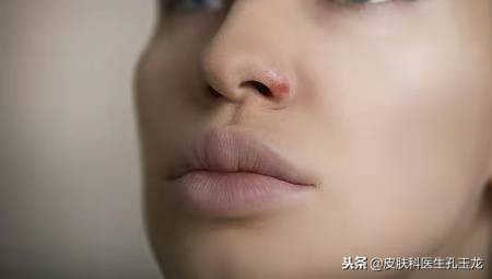 单纯疱疹和上火的区别,脸上的单纯疱疹是上火引起的吗