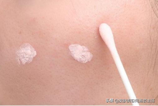 痘痘反反复复，脸上坑坑洼洼，到底是什么原因？