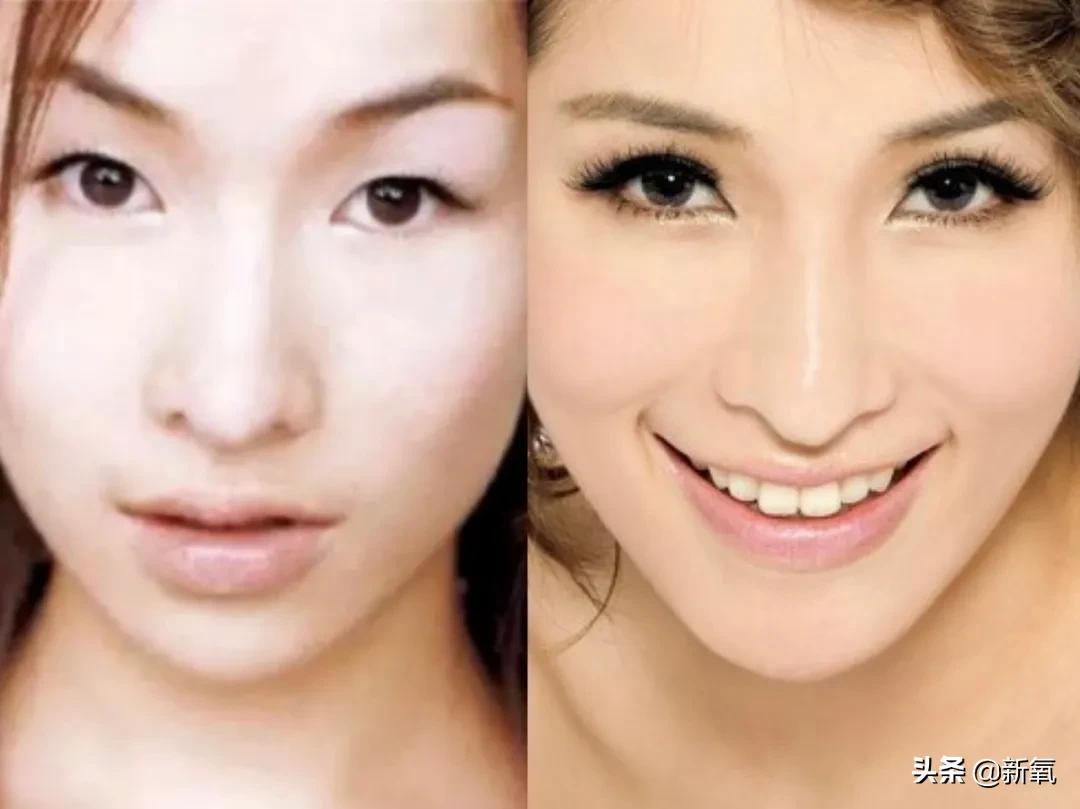 做双眼皮的姐妹还是要慎重,姐妹们你们割双眼皮多少钱