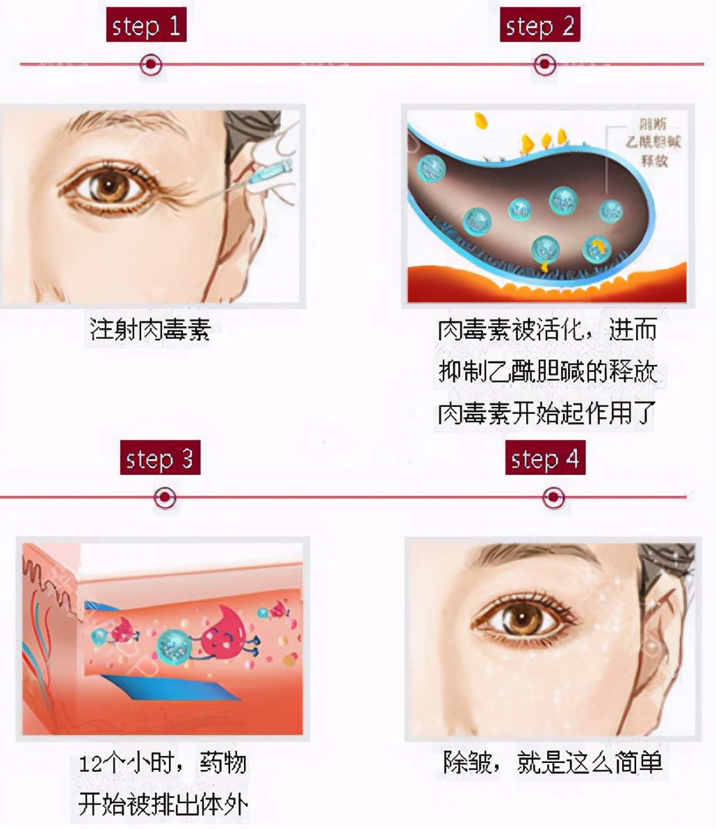 肉毒素和玻尿酸除皱哪个更实惠,如何选择肉毒素和玻尿酸注射除皱