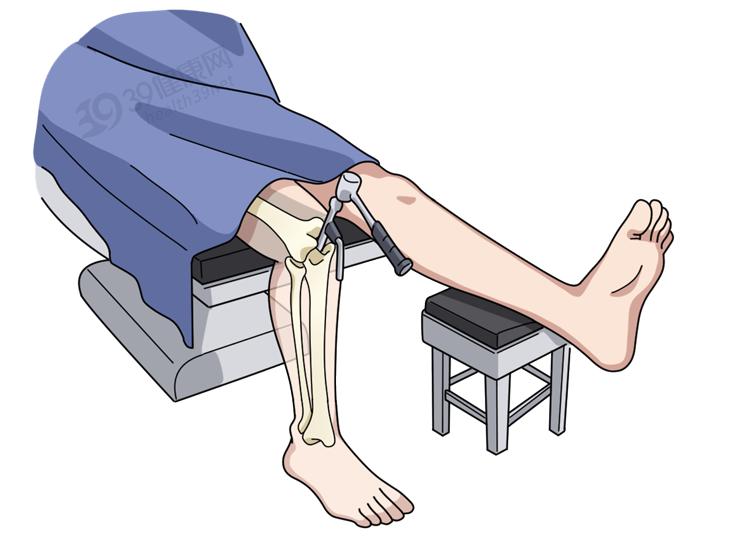 做断骨增高的人怎么样了,做了断骨增高看得出来吗