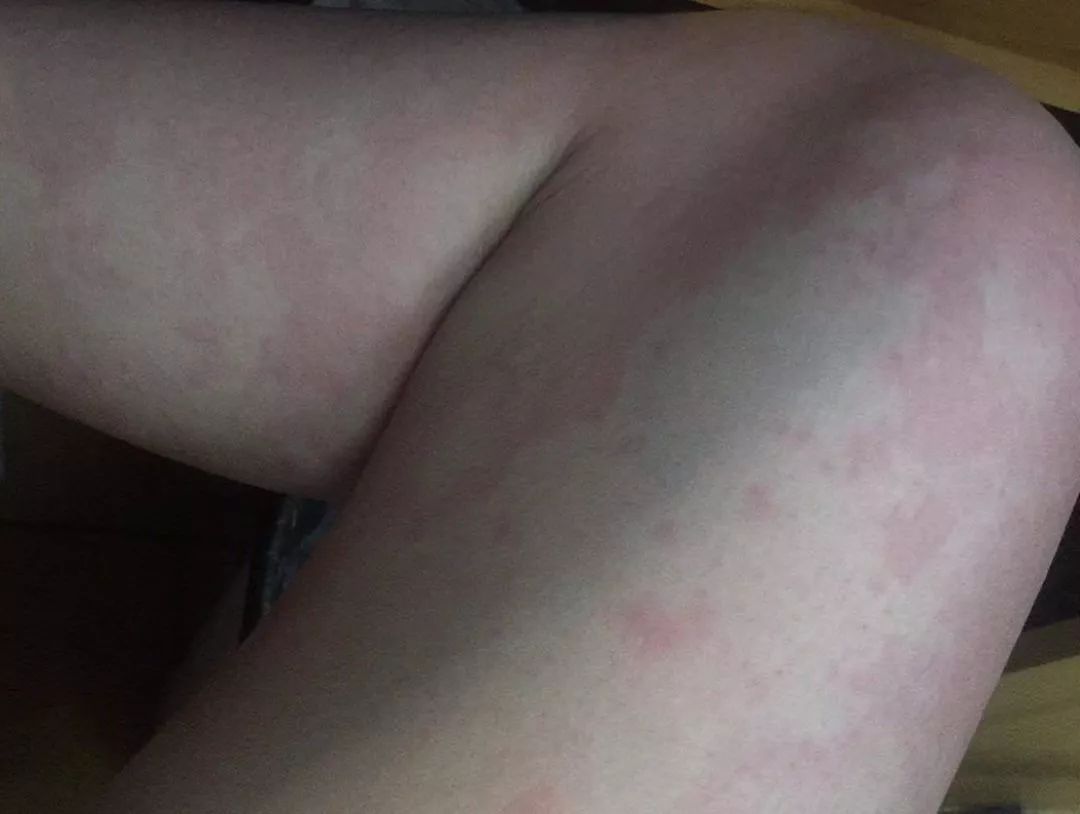 儿童春季常见疾病及治疗,当心这几类传染病近期高发