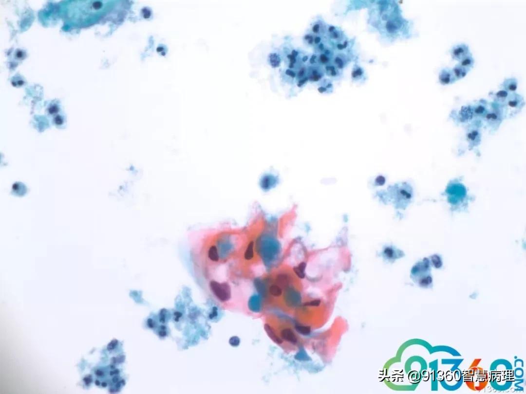 病理宫颈活检lsil是什么意思,宫颈病理检查与tct检查的区别