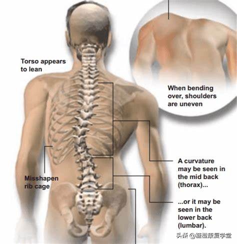 脊柱侧弯头疼怎么缓解,脊柱侧弯什么程度会肩膀疼