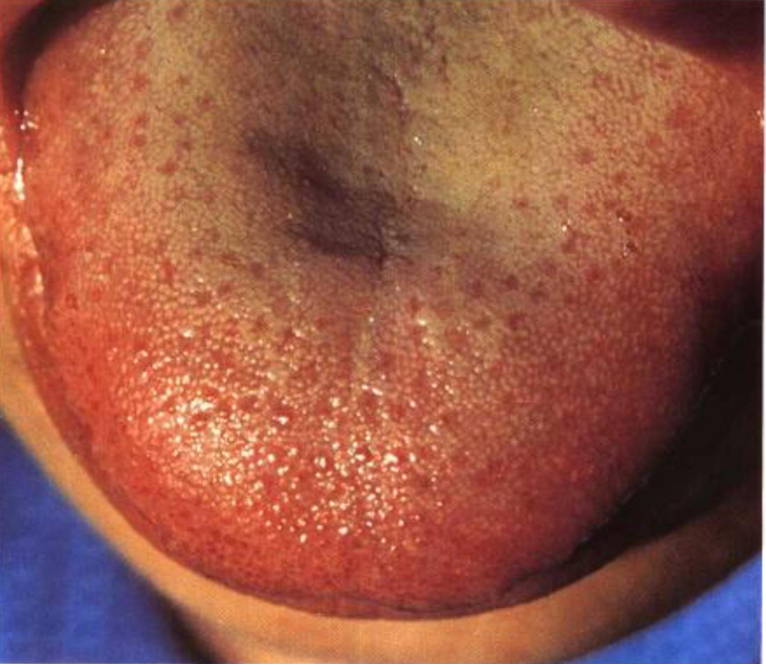 如何从舌苔判断健康,怎样通过舌苔颜色判断身体状况