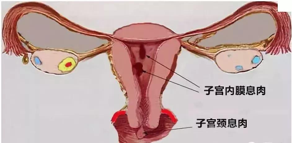什么情况下有息肉会癌变,哪些部位长息肉最严重