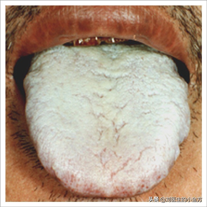 中医舌诊图解100例,中医舌诊图与舌诊口诀