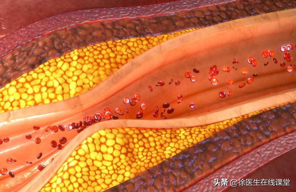 心脏三根血管都堵80%需要下支架吗,下了心脏支架血压低是什么问题