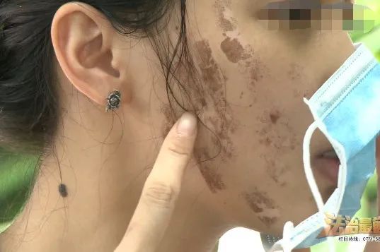 面部皮肤烫伤毁容图片,医院免费治疗毁容女孩