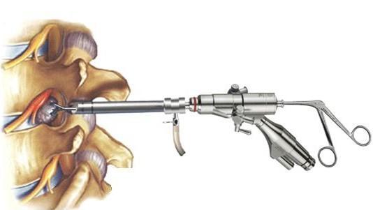 腰椎滑脱和腰椎间盘突出哪个严重,想知道腰椎间盘突出是怎样引起的